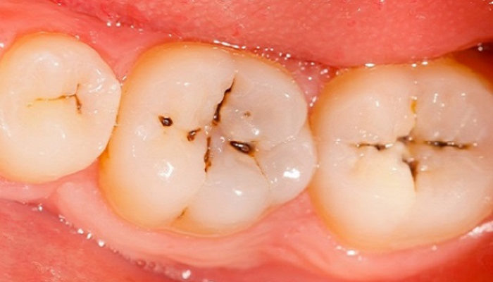 Cavities Treat
