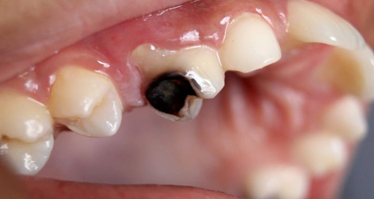 Causes Of Tooth Decay
