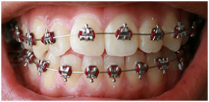 Invisalign vs. braces