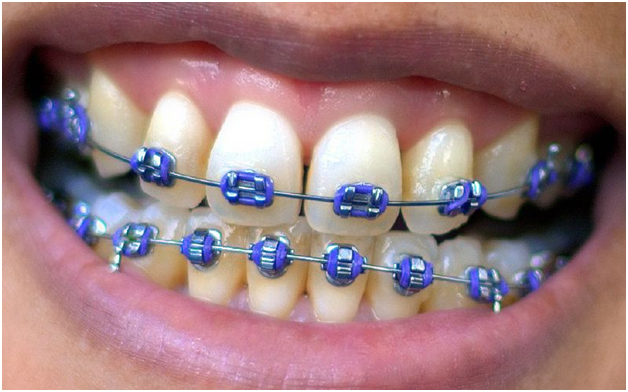 fixed braces